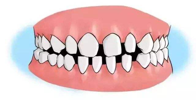 门牙有疏漏缝隙有什么预兆？