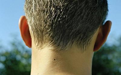 脖子后面有痣代表什么，脖子后面有痣图解