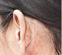 耳背有痣代表什么